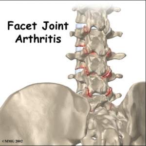 spinal arthritis